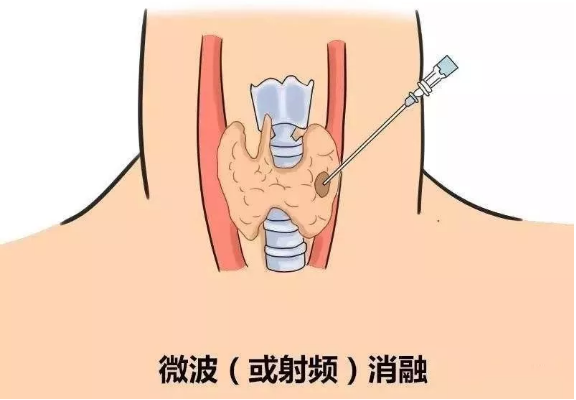 甲状腺结节